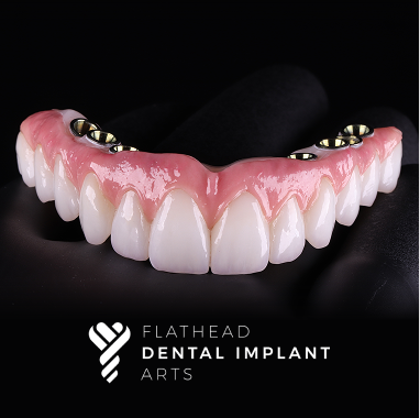 Hybrid Implant Bridge