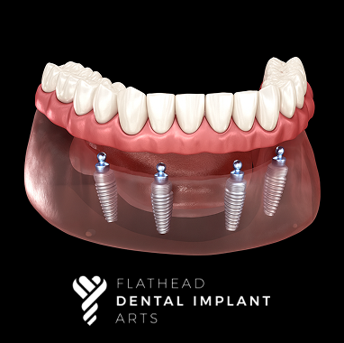 Zirconia Implant Bridge