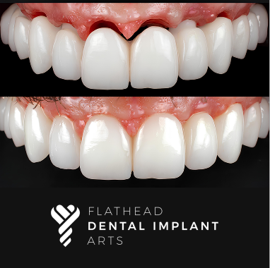Porcelain Implant Bridge